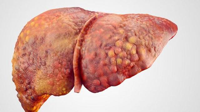 容易出现胆汁淤积的现象,如果不及时治疗还可能会诱发胆汁性肝硬化